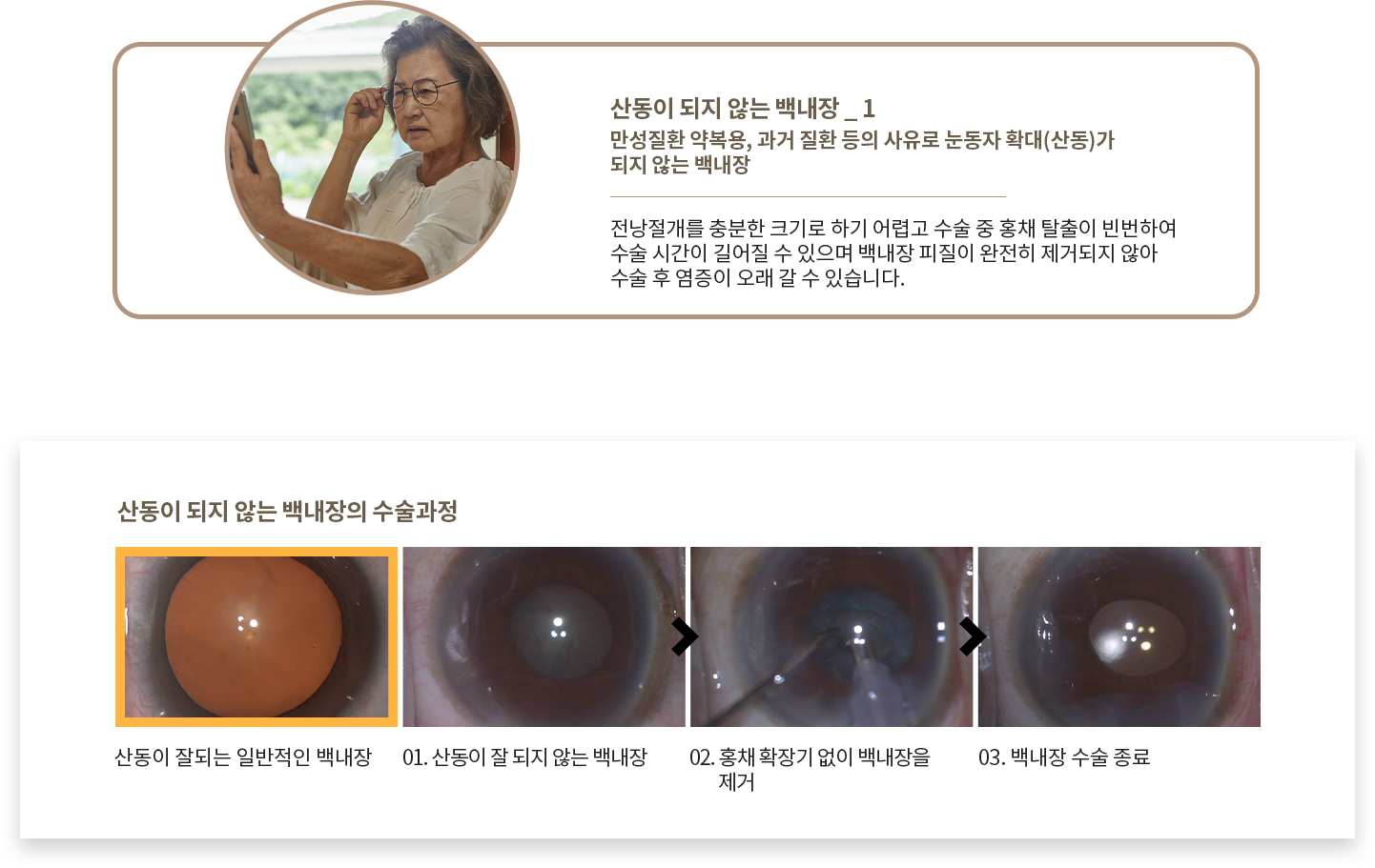 산동 되지 않는 백내장
