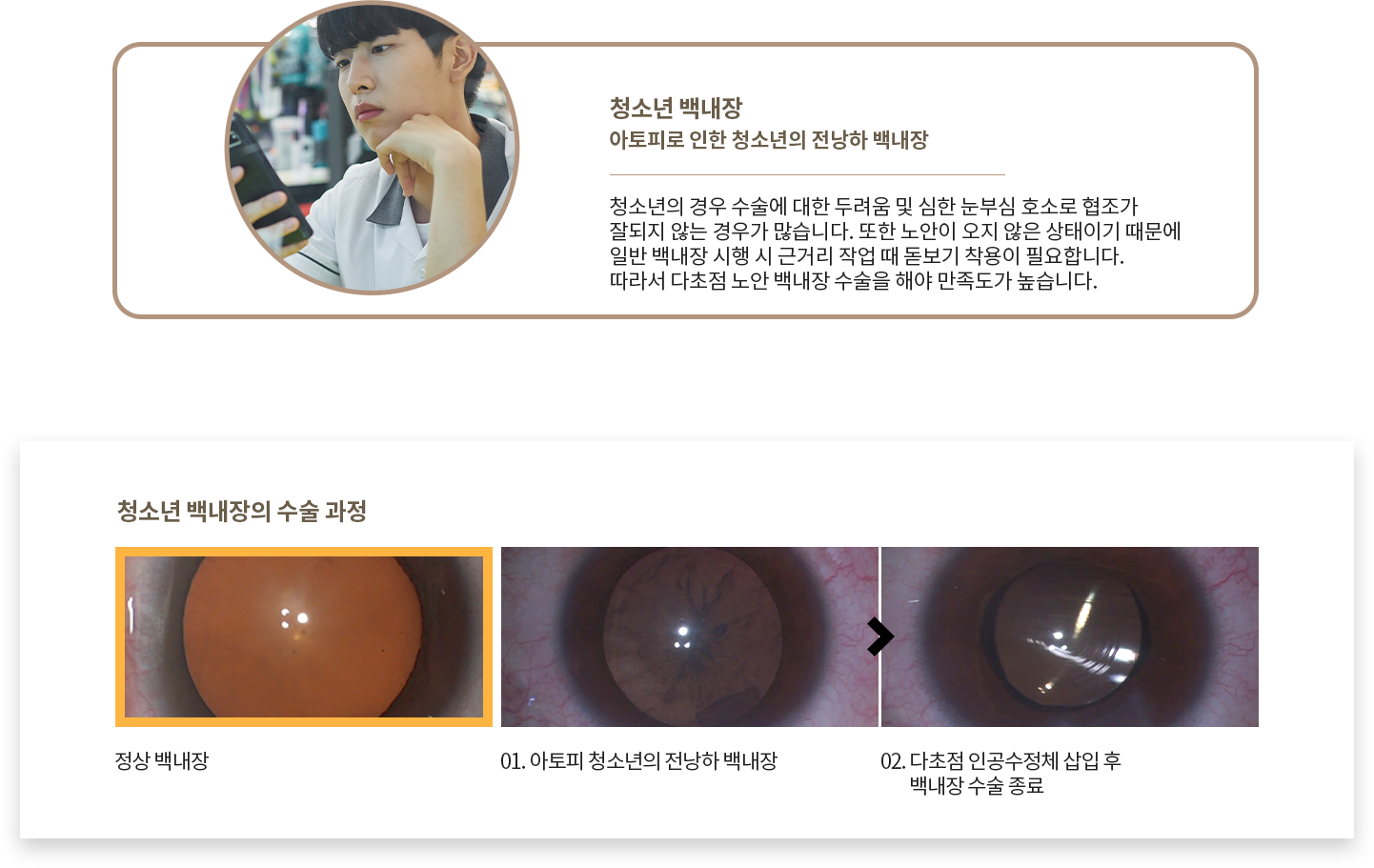 청소년 백내장